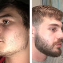 Minoxidil Kirkland 5% + Vitamina Aceleradora