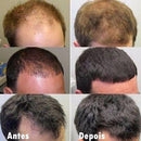 Minoxidil Kirkland 5% + Vitamina Aceleradora