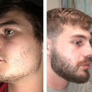 Minoxidil Kirkland 5% + Vitamina Aceleradora