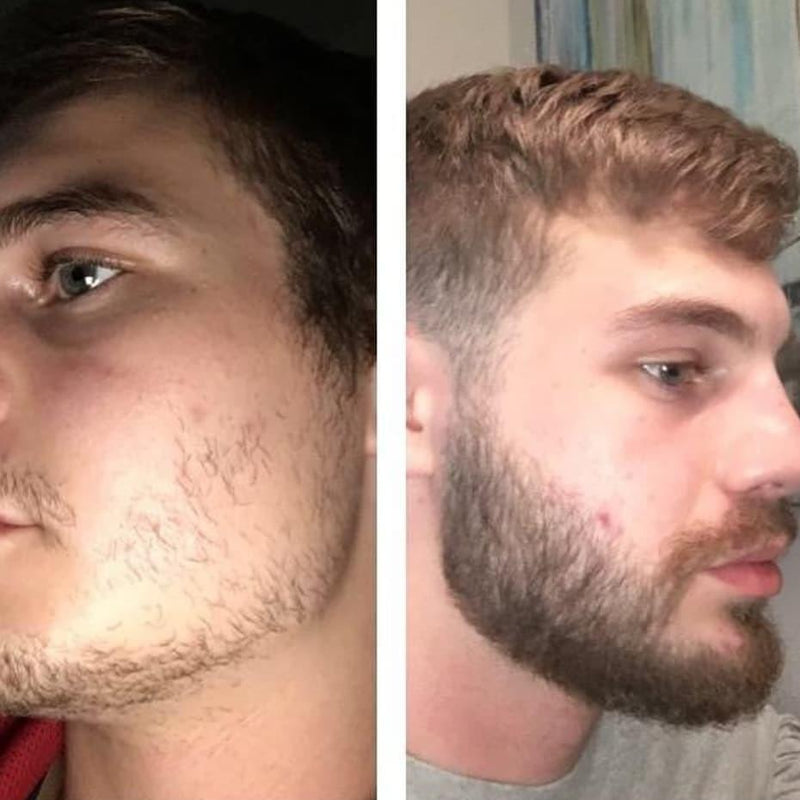 Minoxidil Kirkland 5% + Vitamina Aceleradora